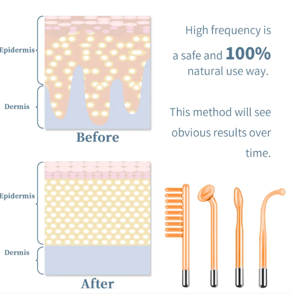 High-Frequency Facial Beauty Device
